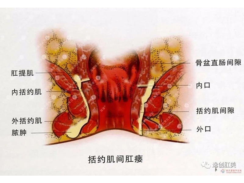 肛瘘