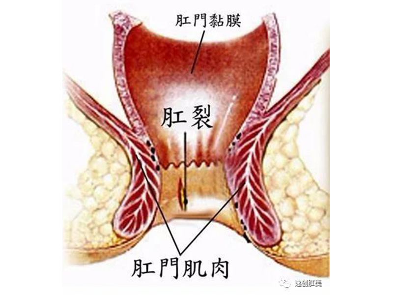 肛裂